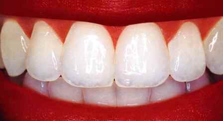 Vì sao sau khi cạo vôi răng thường phải đánh bóng răng?
